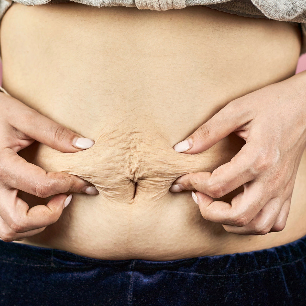 Diastasis Recti vs Belly Fat? What You Need to Know!